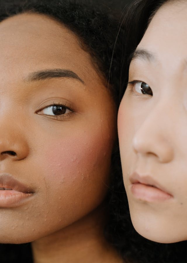 was hilft gegen Akne bei Jugendlichen und Erwachsenen.